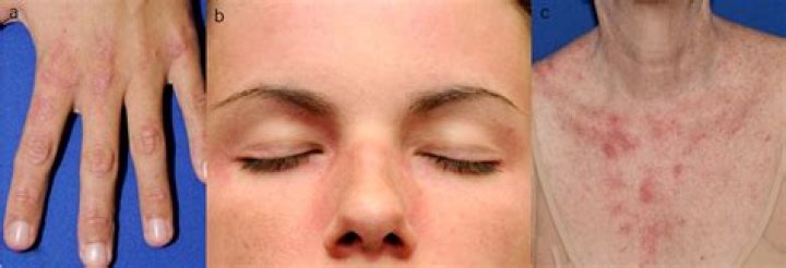 A Violaceous, Photodistributed Cutaneous Eruption and Leg Ulcer in a
