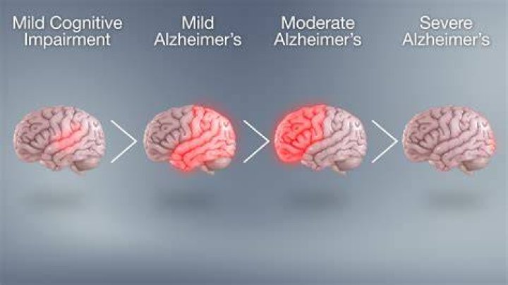 Alzheimer&rsquo;s Disease Cancer Quick Facts