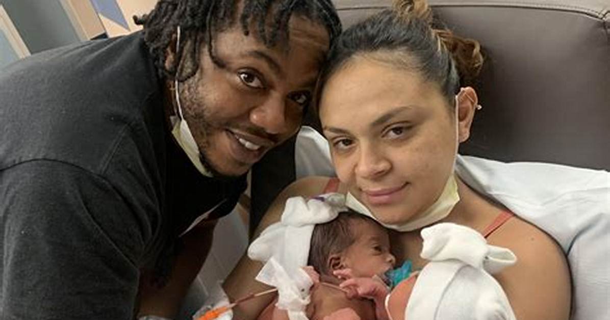 Amanda Arciniega and James Finley's Conjointed Twins Seperated