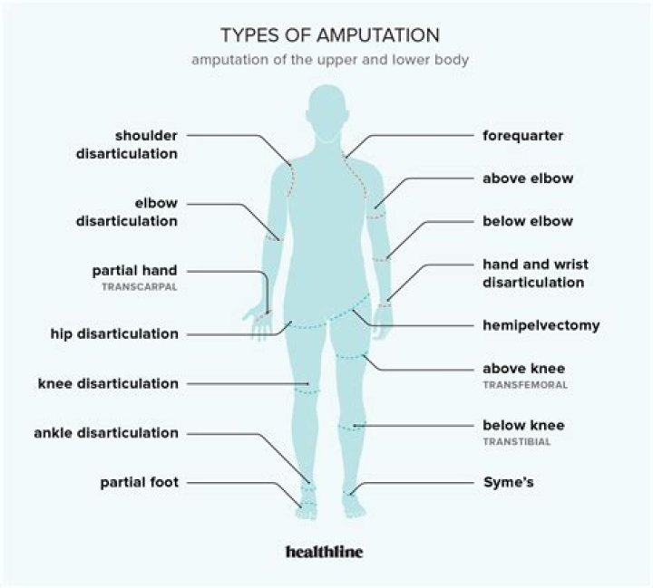 Amputation causes, types of amputation and amputation complications