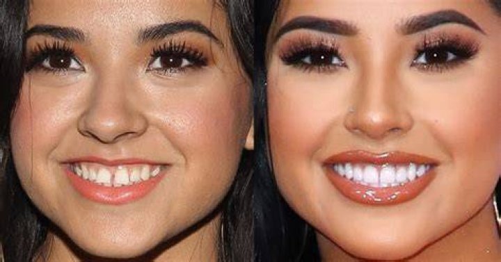 Becky G Teeth Gap Before And After TeethWalls