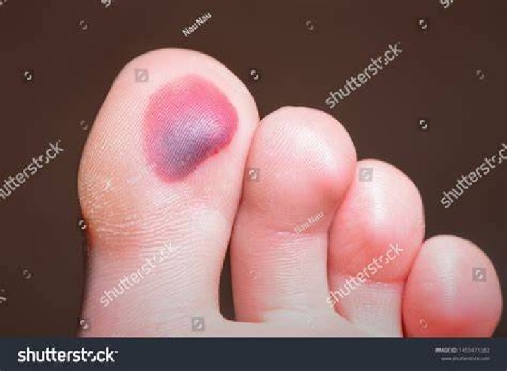 Blood Blister On Foot Do's and Don'ts