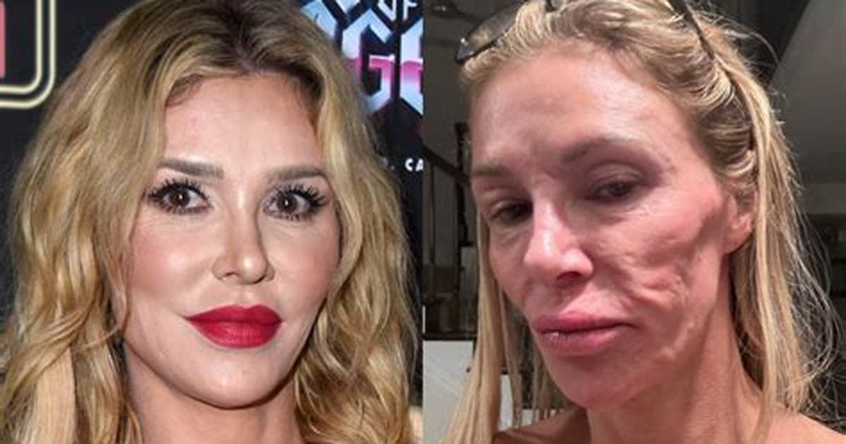 Brandi Glanville Previously Explained Why Her Mouth Looks a Little Wonky