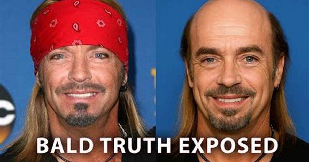 Bret Michaels Bald and Why Does He Always