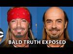 Bret Michaels Bald and Why Does He Always