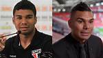 Casemiro Surgery | Nose Job Before and After Photos