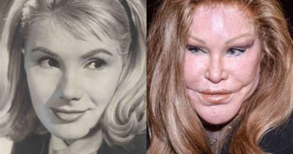 Cat Woman Plastic Surgery Before and After | Why Jocelyn Wildenstein Face Looks So Different