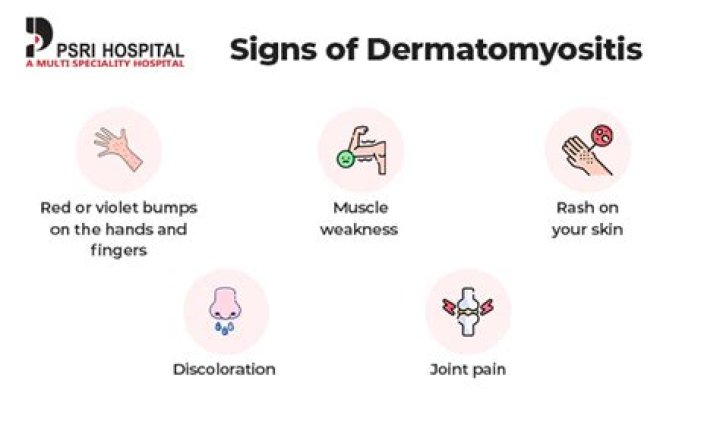 Dermatomyositis Flare Up Symptoms An identifying factor for