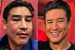 Did Mario Lopez Get a Face Lift Surgery?