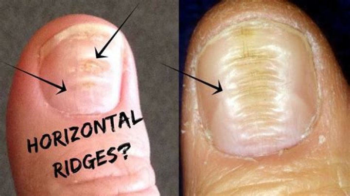 Do You Have These Horizontal Ridges(Lines) On Your Nails?Palmistry