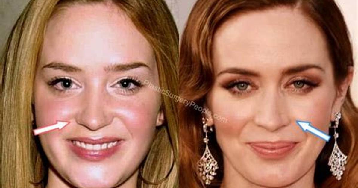 Emily Blunt Botox and Nose Surgery: Did She Underwent Surgery? | How Does Emily Look Like After Surgery?