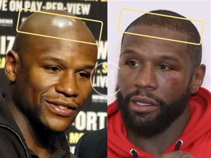 Floyd Mayweather Hair Transplant Hair Loss & Technical Analysis