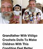 Grandfather with Vitiligo Crochets Dolls for Kids Living with the Same Condition: “They Feel Represented”