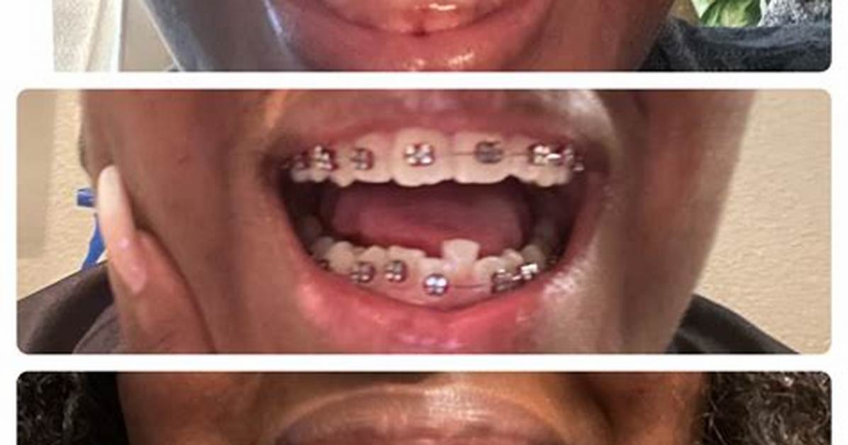Has He Used Braces? Health Update