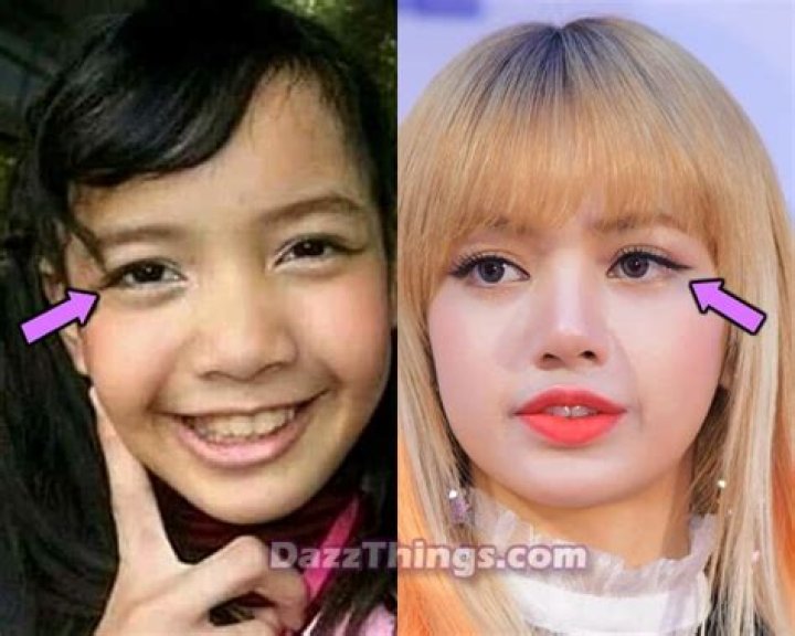 Has Lisa Had Plastic Surgery? Her Transformation in Photos From