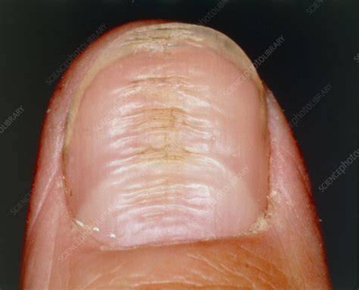 Horizontal ridges on fingernail or nail dystrophy Stock Image M140