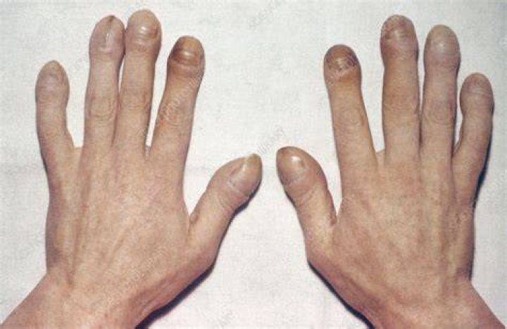 Hypertrophic Osteoarthropathy Stock Image C014/4438 Science Photo