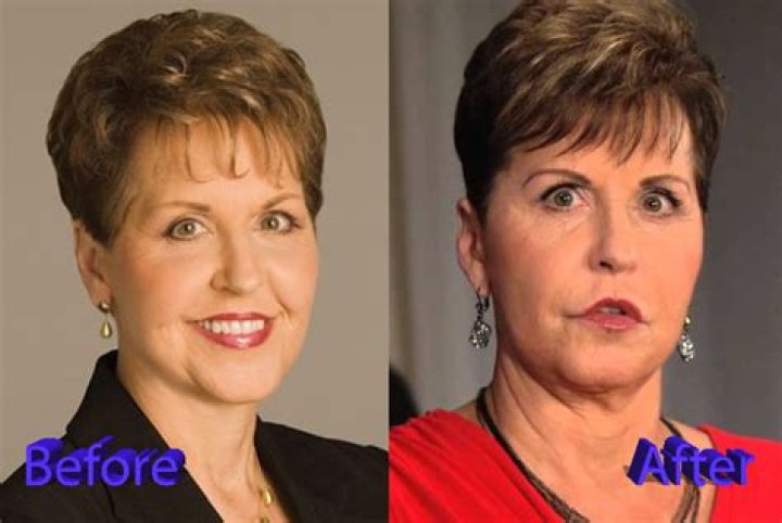 Joyce Meyer Plastic Surgery Diversity News Magazine Plastic surgery