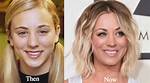 Kaley Cuoco Botox: Before and After Photos