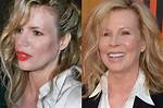 Kim Basinger Plastic Surgery Before and After- Health Update