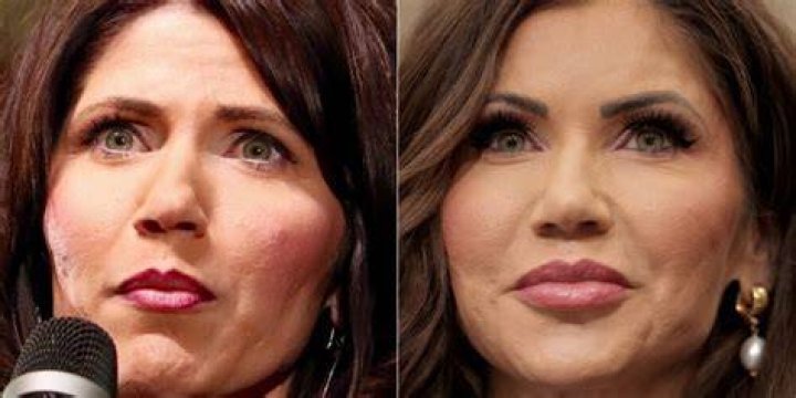Kristi Noem Before After Plastic Surgery
