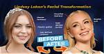 Lindsay Lohan Face Lift and Nose Job | Before and After Photos