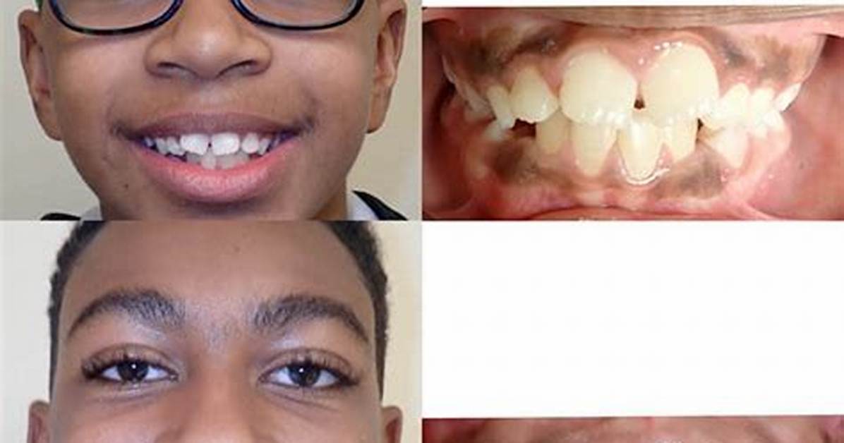 Lucy Bronze Teeth Before and After: Braces or Whitening?