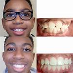 Lucy Bronze Teeth Before and After: Braces or Whitening?
