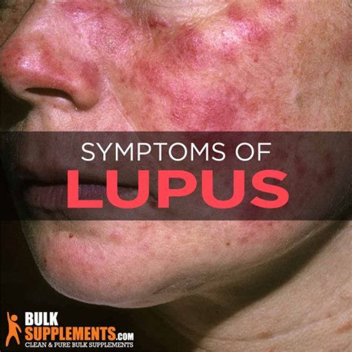 Lupus Causes Symptoms And Treatment Information Piedmont Healthcare Riset