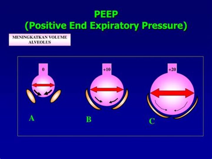 Mechanical Ventilation PEEP (Positive End Expiratory Pressure