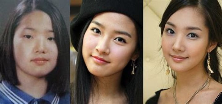 Park Min Young plastic surgery Nose Job, Double eyelid surgery, Facelift