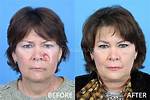 Plastic Surgery Before & After