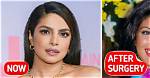 Priyanka Chopra Says a Botched Medical Procedure Led to Several Corrective Cosmetic Surgeries