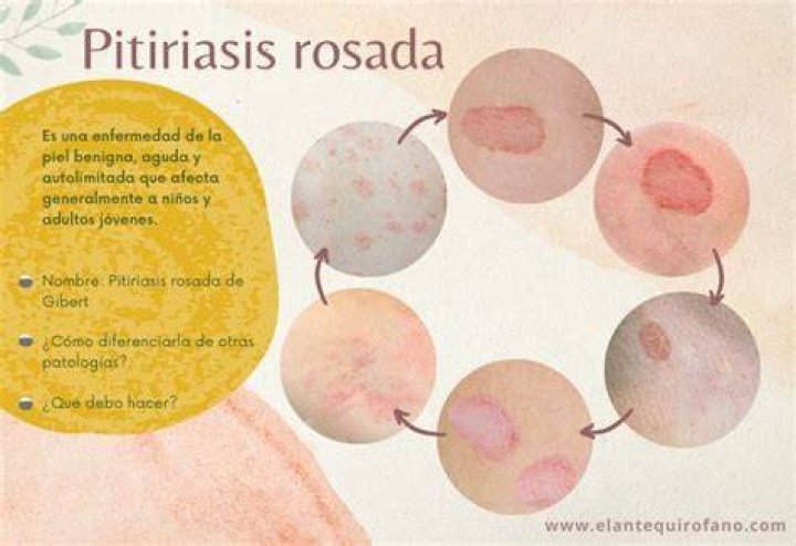 &iquest;Que es la Pitiriasis Rosada? (Causas, S&iacute;ntomas y Tratamiento)