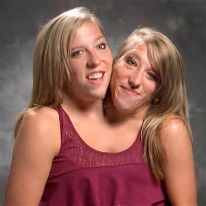 Rare Conjoined Twins Abby and Brittany Share Their Exciting News With