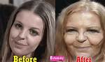 Sally Thomsett Face Surgery: Before and After Pictures
