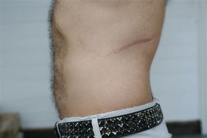 Scar You can save someone's life. You need only one kidney&hellip; Flickr
