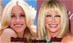 Suzanne Somers Plastic Surgery and Face Lift Photo