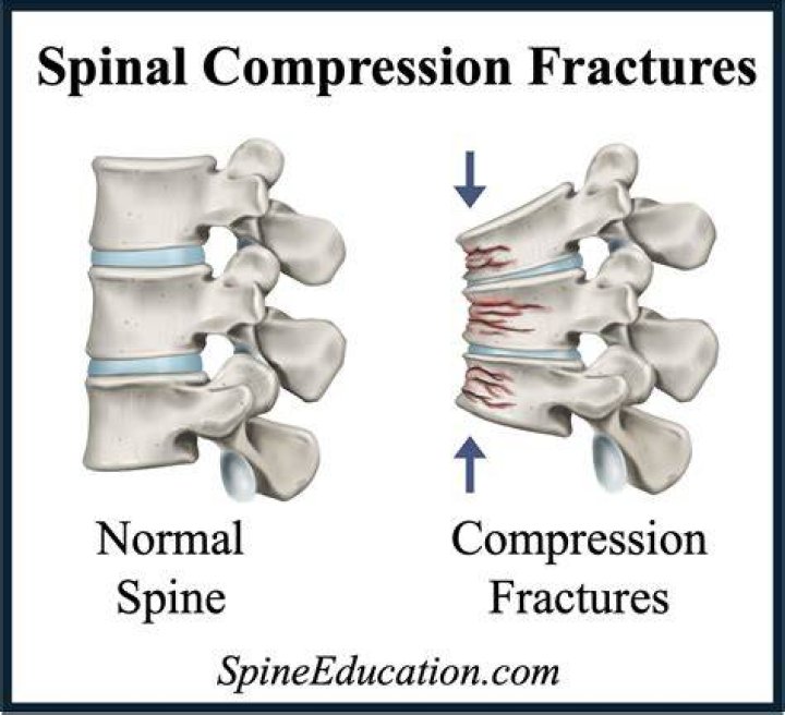 Thoracic Spine Compression Fractures Vertebra Plana