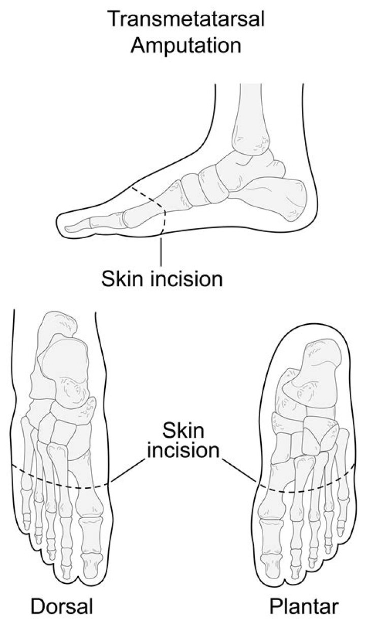 Transmetatarsal Amputation (TMA) and Toe Amputation Treatments