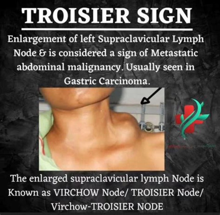 Troisier's sign Enlargement of the Virchow's lymph nodes MEDizzy