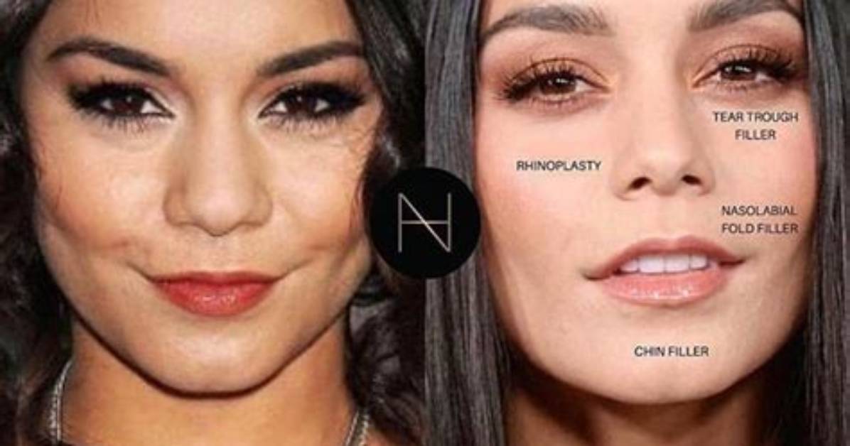 Vanessa Hudgens Botox | Before and After Photos 2023