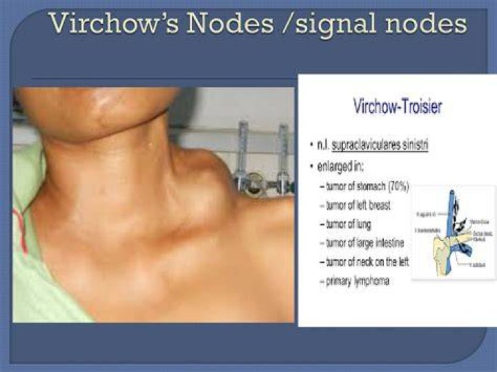Virchow&rsquo;s node? r/lymphnodes