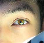 What Happened to Seth Fedelin Eyes | Is He Suffering from Disease