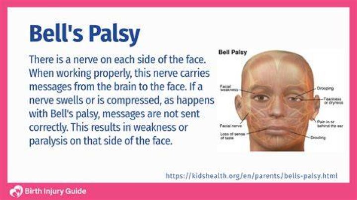 What Is Bell&rsquo;s Palsy? Angelina Jolie Reveals She Was Diagnosed With