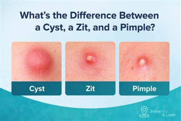 Whats The Difference Between Cysts Fibroids And Polyps Fibroids My