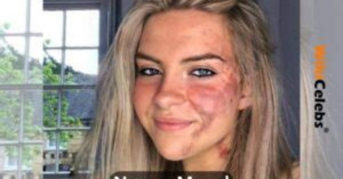 Who Is Nancy Morel? Wiki, Age, Height, Parents, Skin Condition, Net Worth, Boyfriend, Biography & More