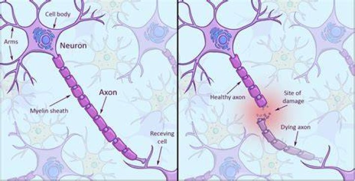 Why Do Brain Cells Die In Alzheimer Patients Dementia Talk Club