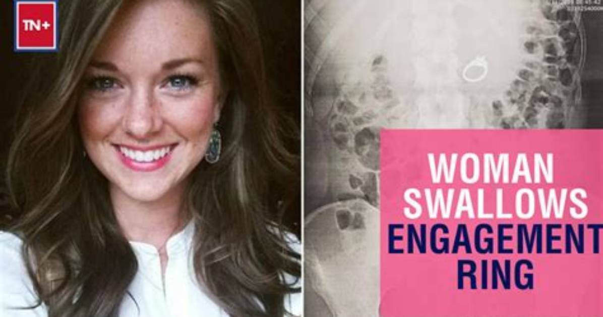 Woman Swallows Her Engagement Ring in a Dream — and in Real Life